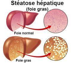 Stéatose hépatique